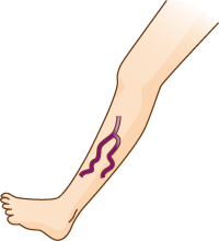 下肢静脈瘤イメージ